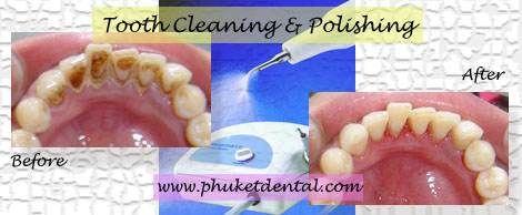 Tooth Cleaning&Air Flow/Polishing at Phuket Dental Clinic,Thailand